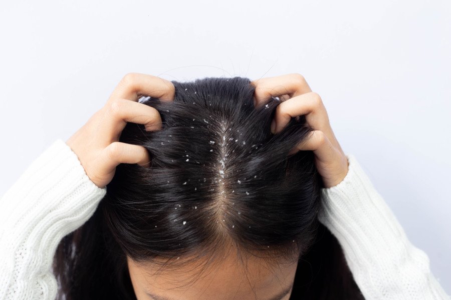 Winter Dandruff
