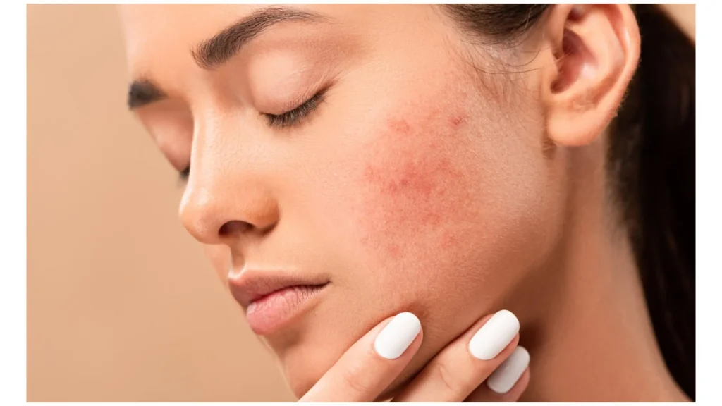 How to Remove Pimples Naturally