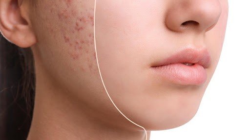 How to Remove Pimples Naturally